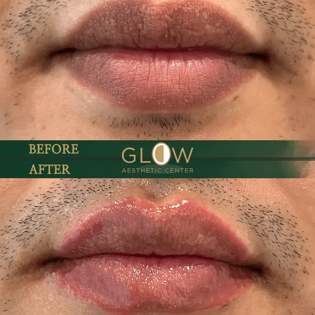 Lip-Filler-Before-and-After-Encino-CA-100