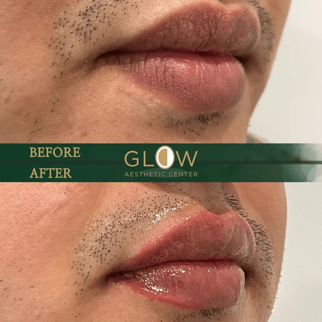 Lip-Filler-Before-and-After-Encino-CA-101