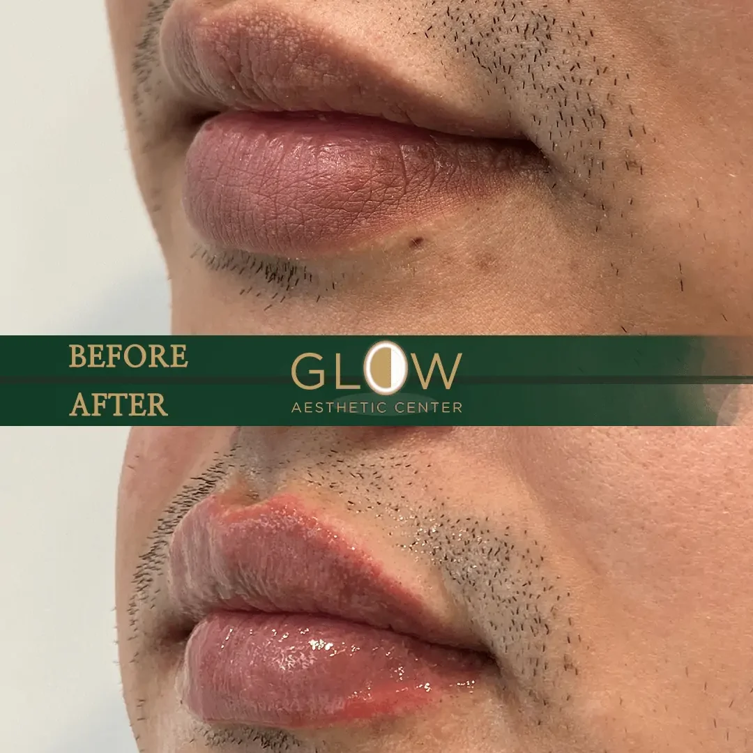 Lip-Filler-Before-and-After-Encino-CA-102