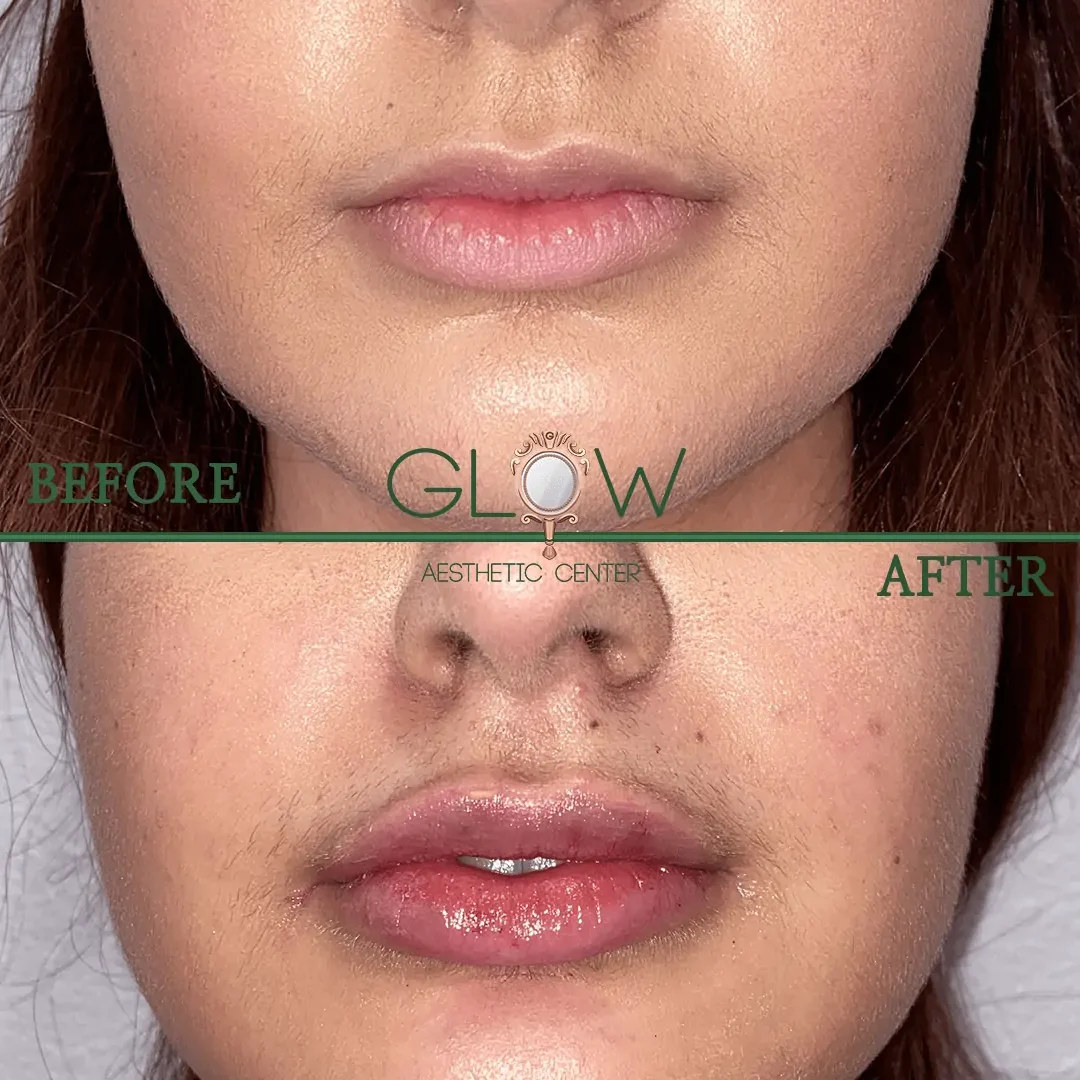 Lip-Filler-Before-and-After-Encino-CA-103