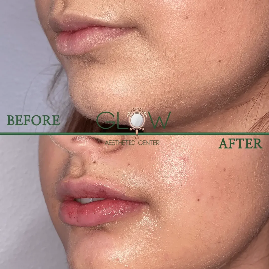 Lip-Filler-Before-and-After-Encino-CA-104