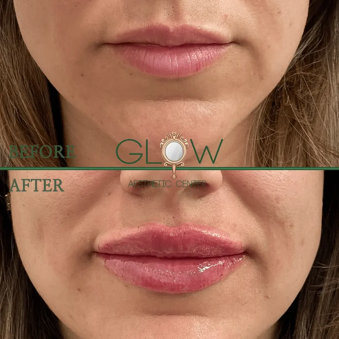 Lip-Filler-Before-and-After-Encino-CA-105