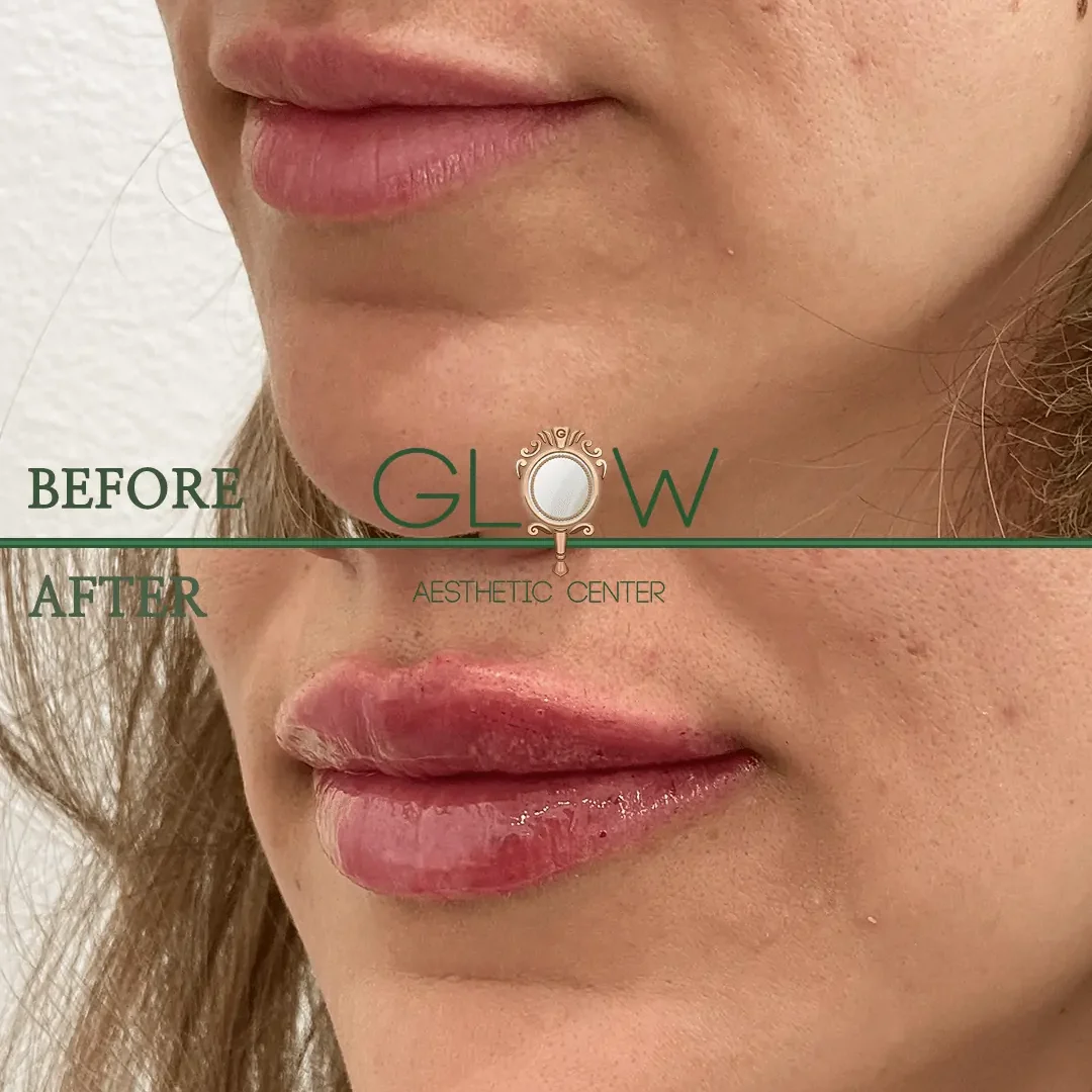Lip-Filler-Before-and-After-Encino-CA-106