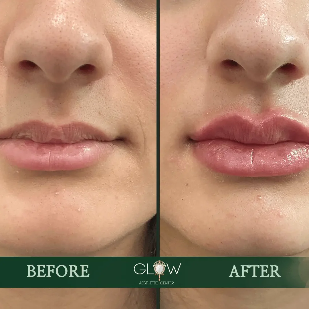 Lip-Filler-Before-and-After-Encino-CA-107