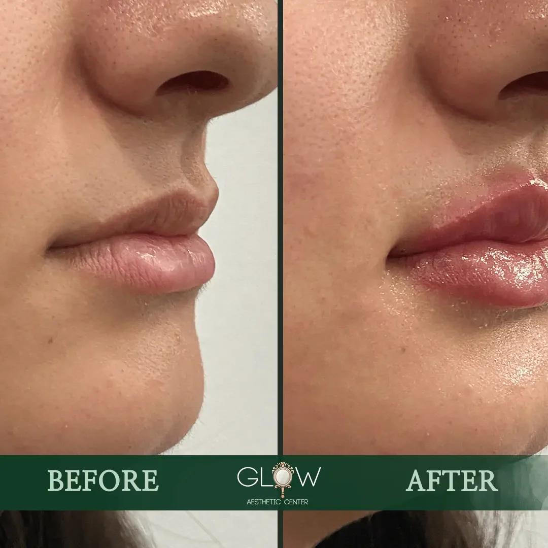 Lip-Filler-Before-and-After-Encino-CA-108