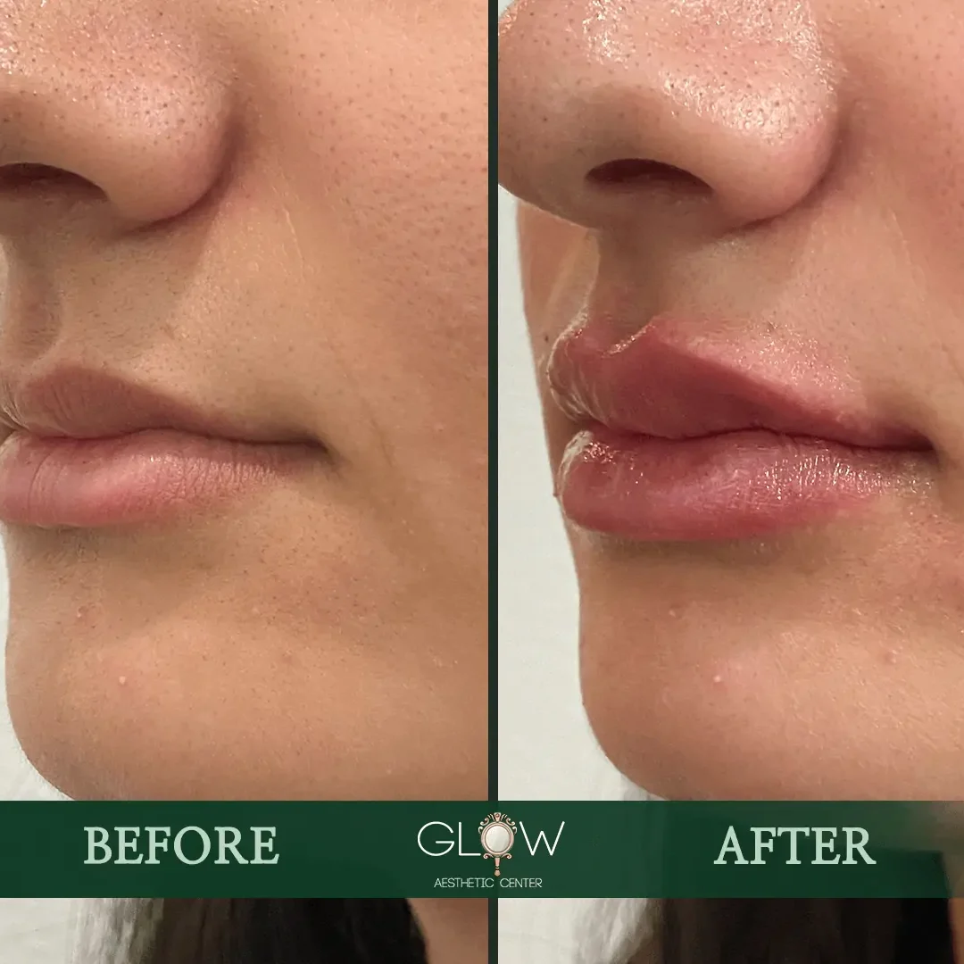 Lip-Filler-Before-and-After-Encino-CA-109