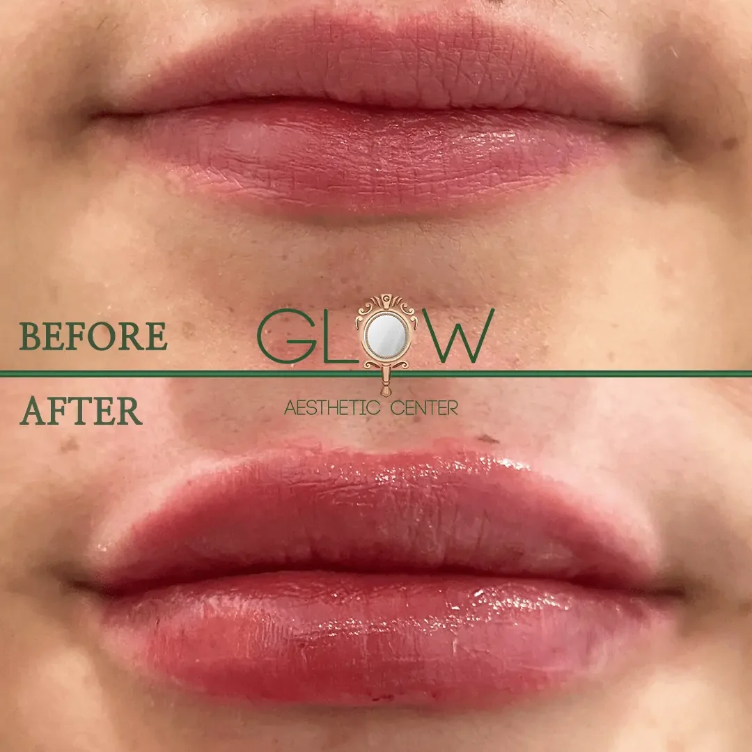 Lip-Filler-Before-and-After-Encino-CA-110