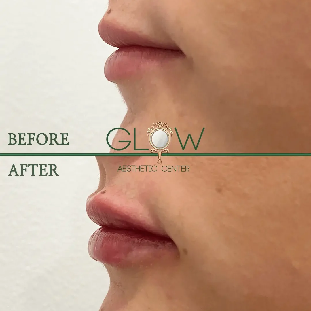 Lip-Filler-Before-and-After-Encino-CA-111