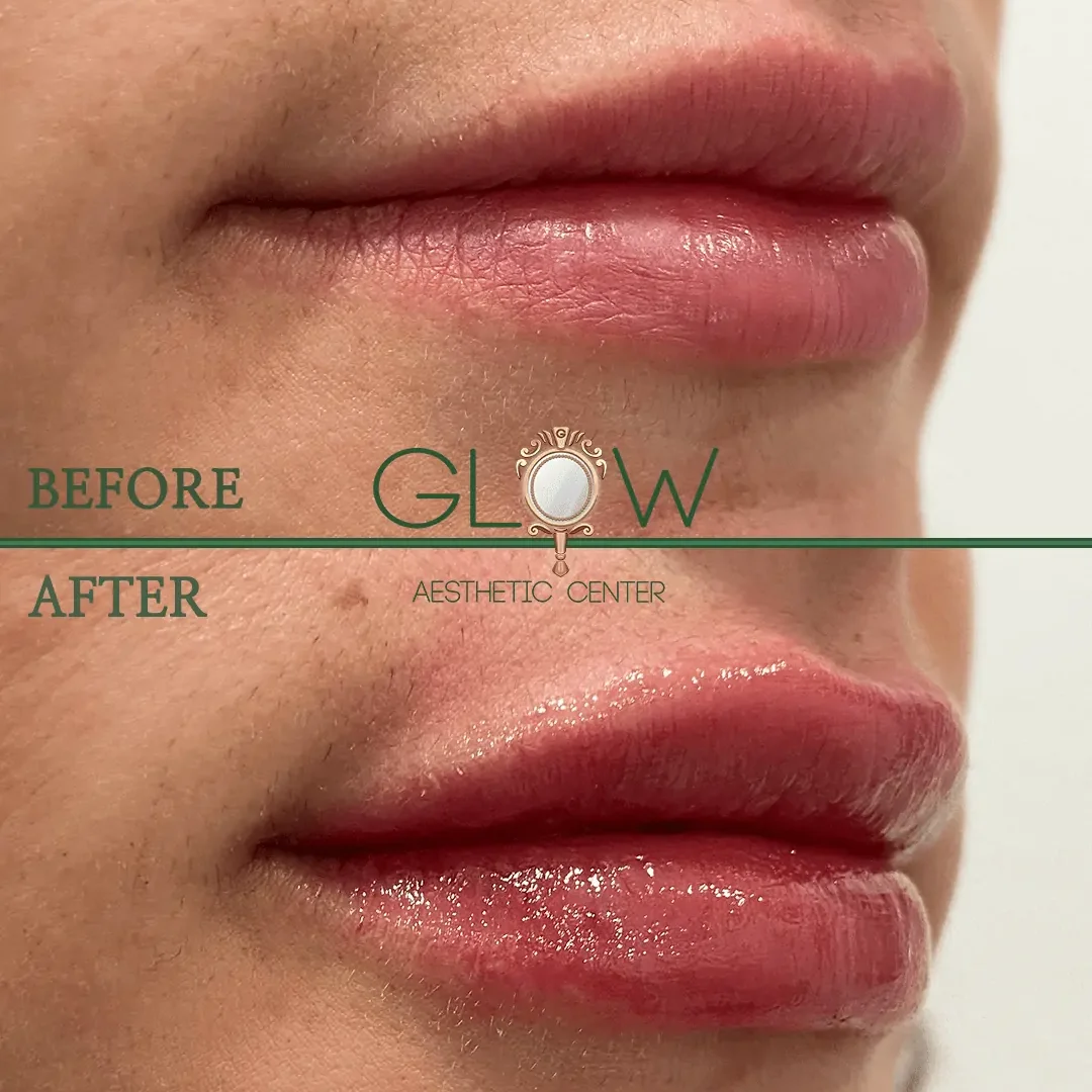 Lip-Filler-Before-and-After-Encino-CA-112