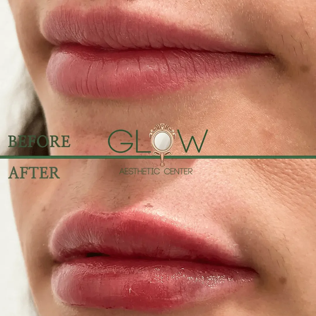 Lip-Filler-Before-and-After-Encino-CA-113