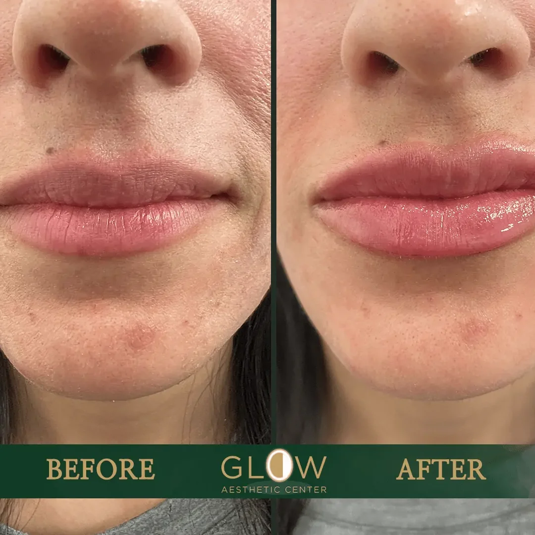 Lip-Filler-Before-and-After-Encino-CA-114