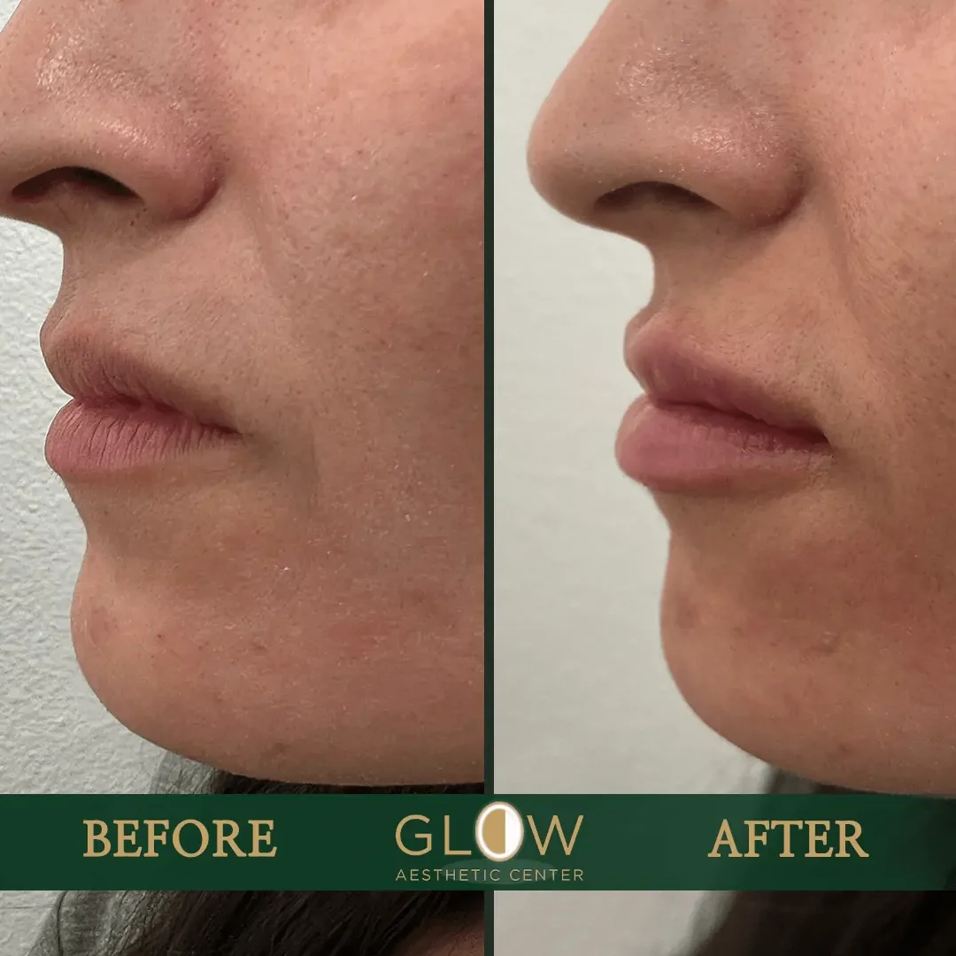 Lip-Filler-Before-and-After-Encino-CA-115