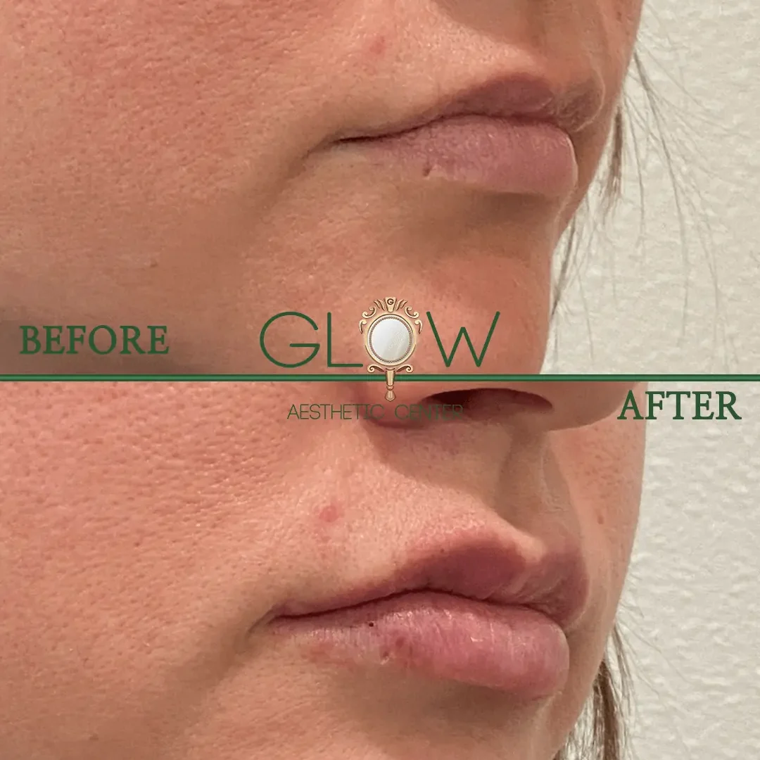 Lip-Filler-Before-and-After-Encino-CA-116