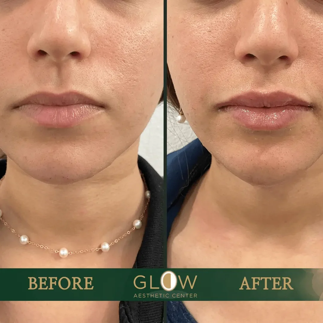 Lip-Filler-Before-and-After-Encino-CA-117