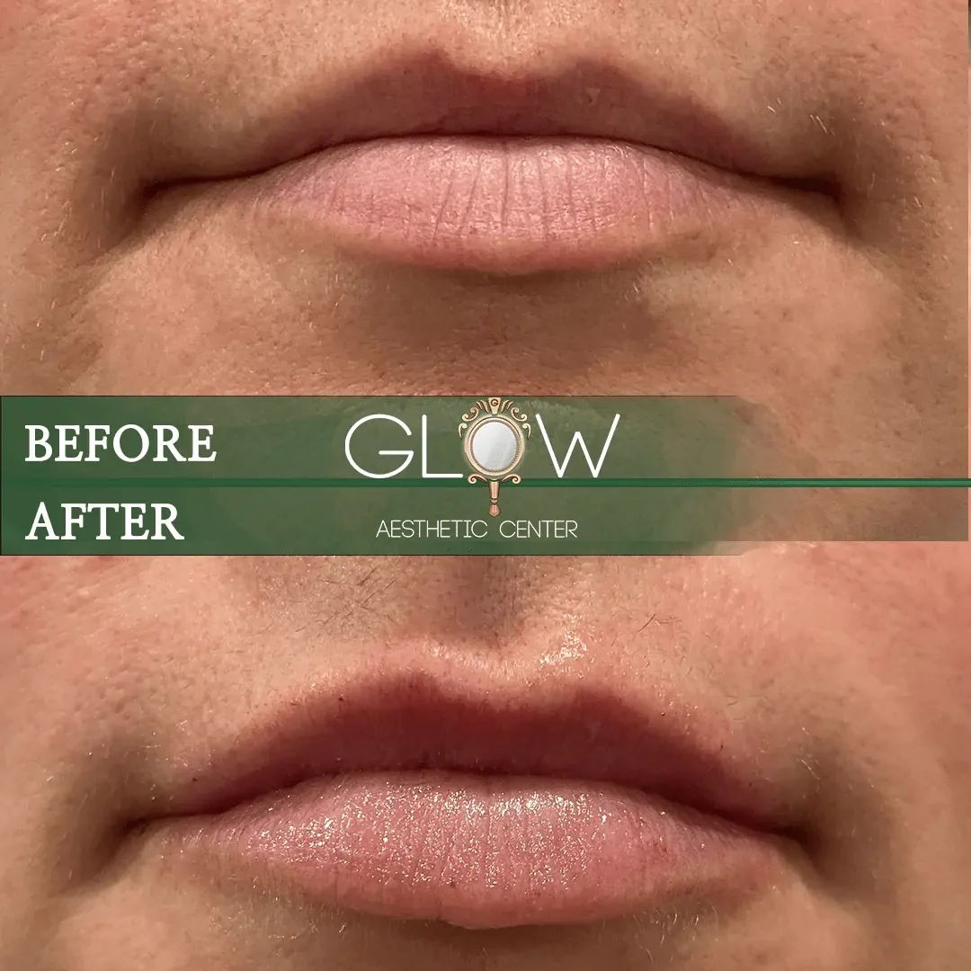 Lip-Filler-Before-and-After-Encino-CA-70