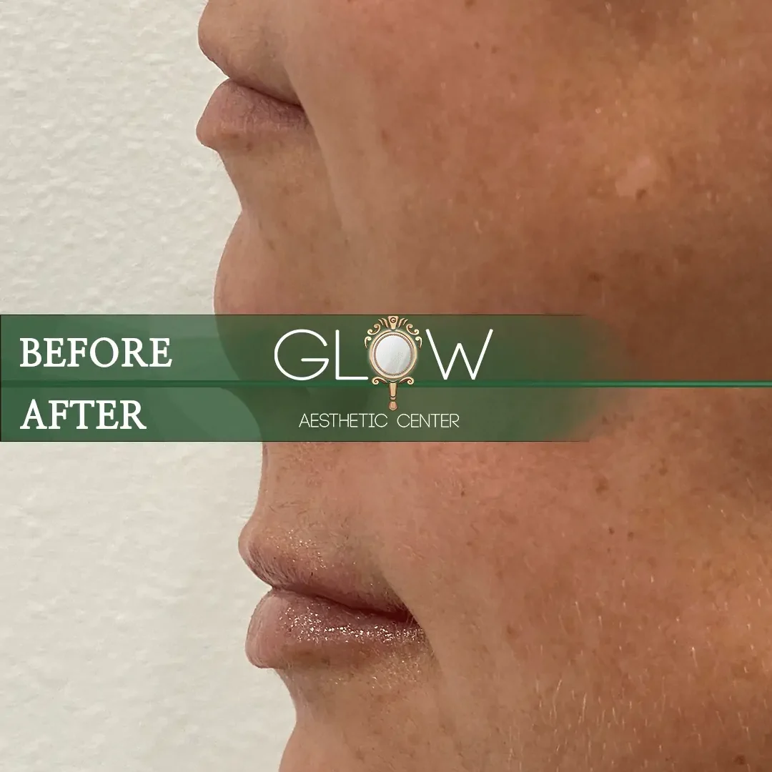 Lip-Filler-Before-and-After-Encino-CA-71