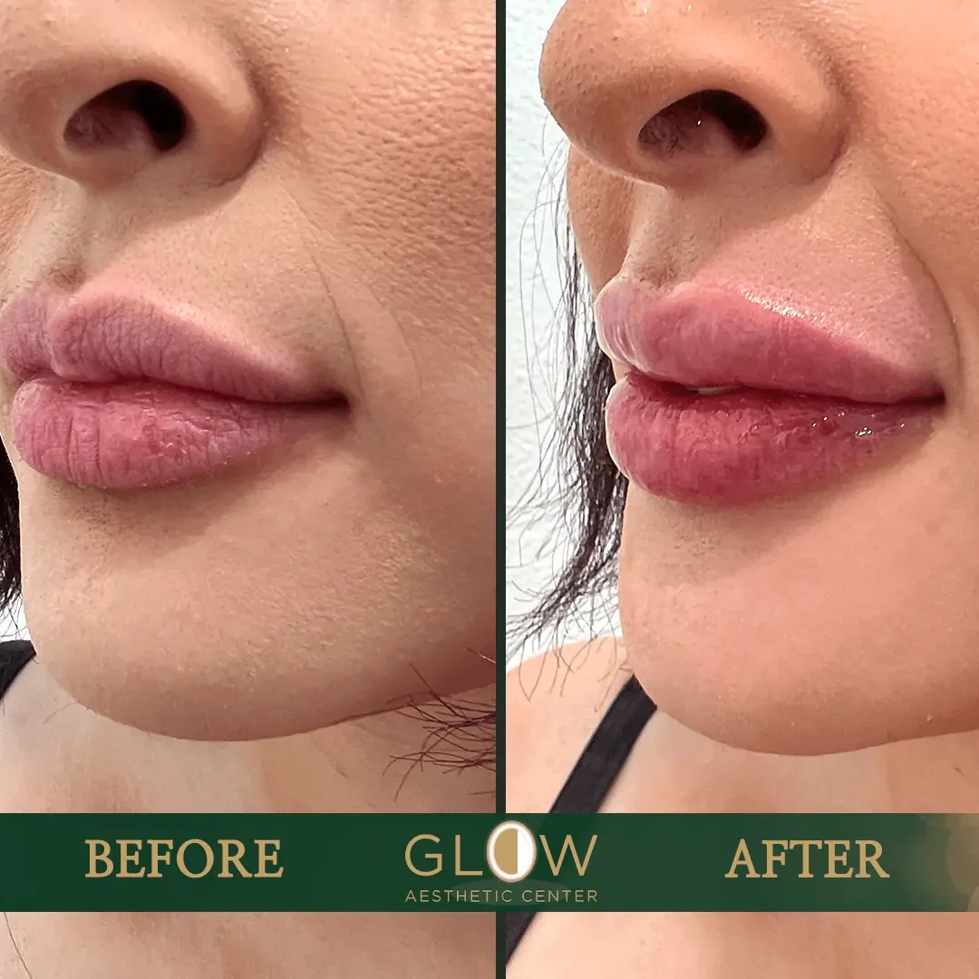 Lip-Filler-Before-and-After-Encino-CA-72