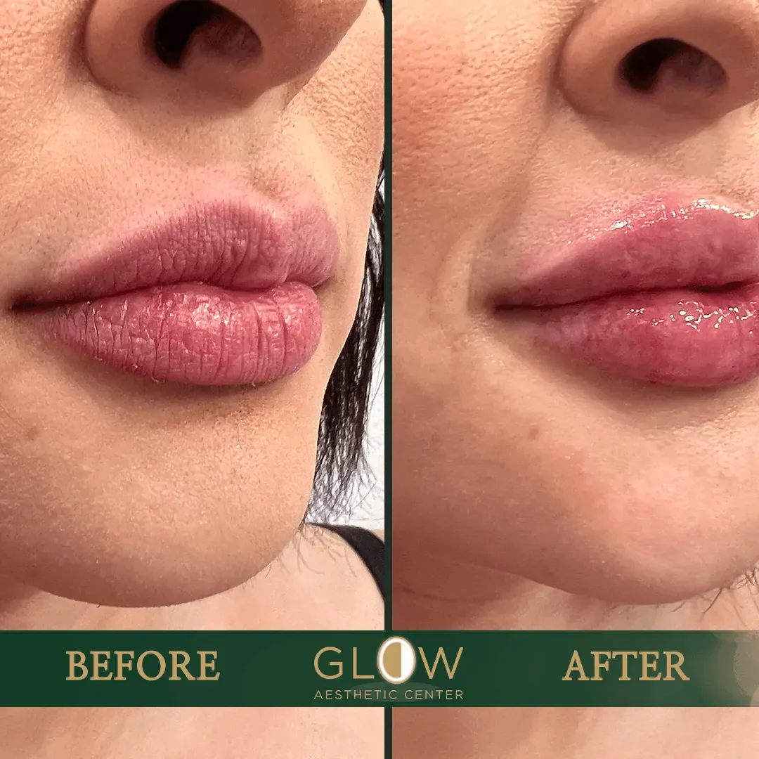 Lip-Filler-Before-and-After-Encino-CA-73
