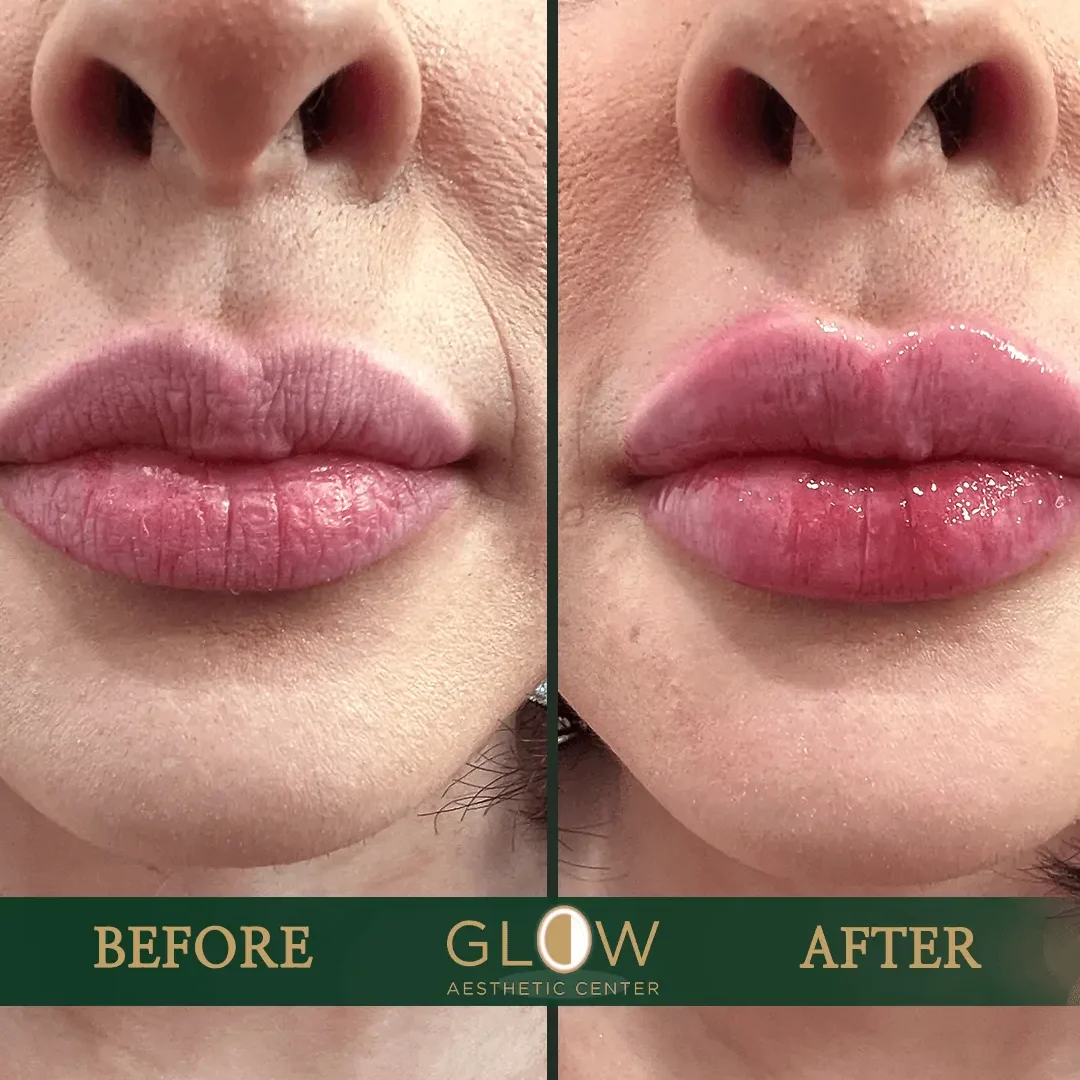 Lip-Filler-Before-and-After-Encino-CA-74