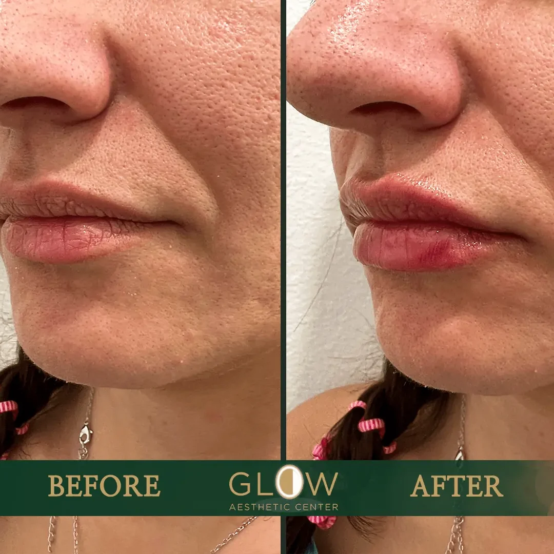 Lip-Filler-Before-and-After-Encino-CA-79