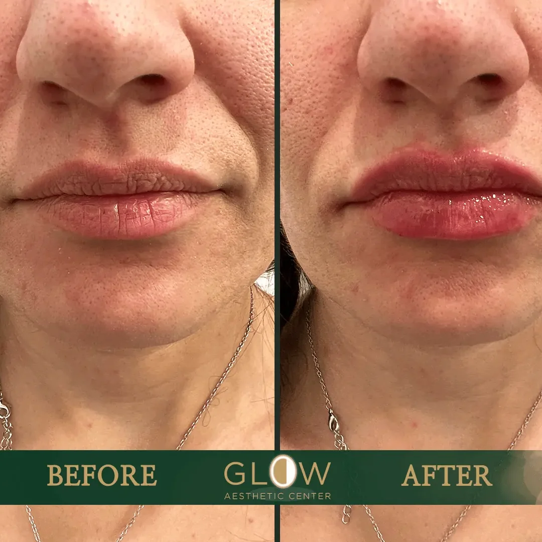 Lip-Filler-Before-and-After-Encino-CA-80