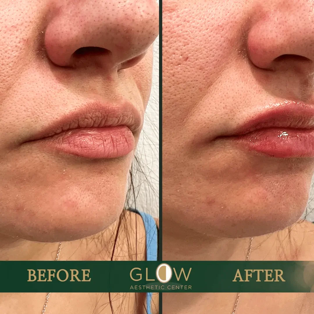 Lip-Filler-Before-and-After-Encino-CA-81