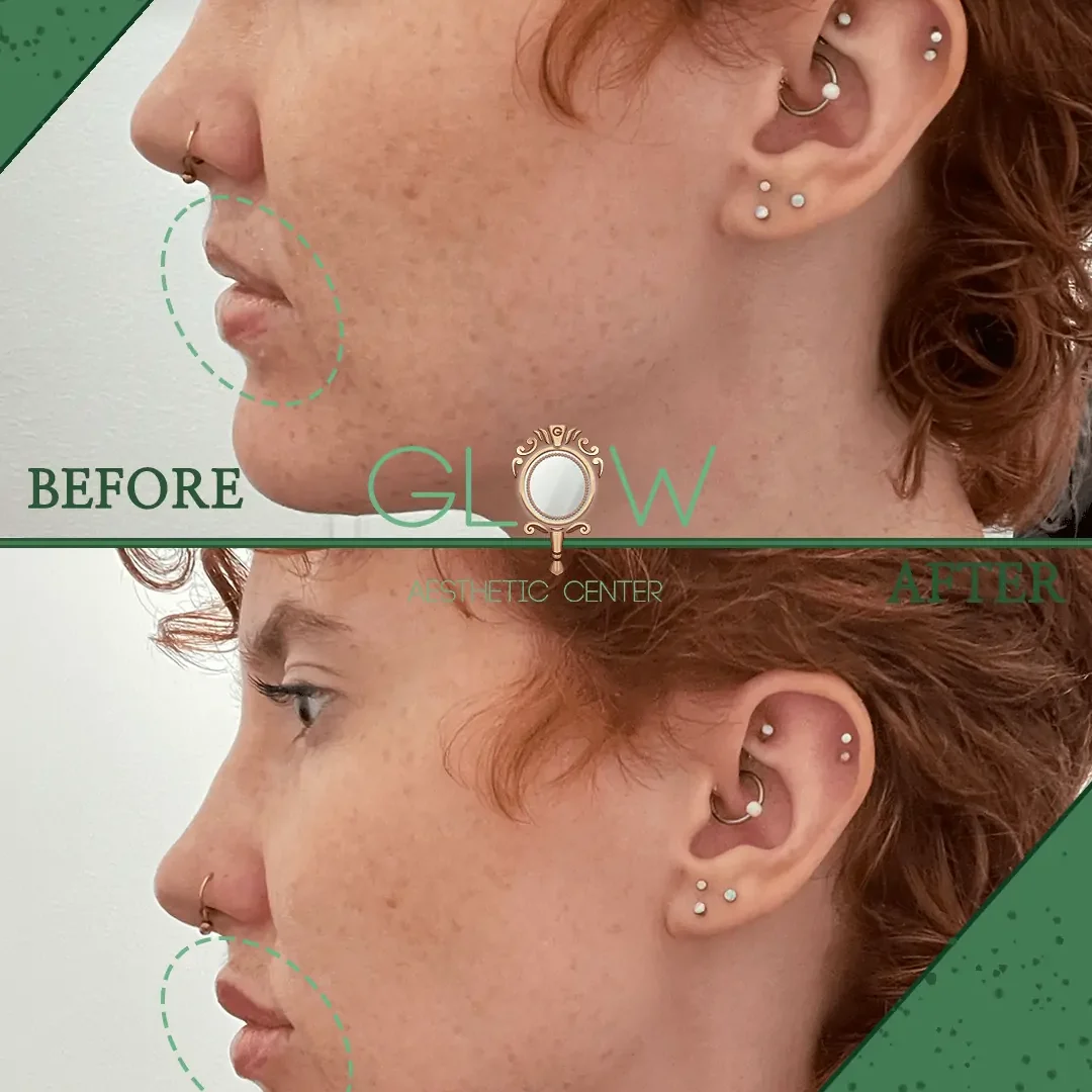 Lip-Filler-Before-and-After-Encino-CA-82