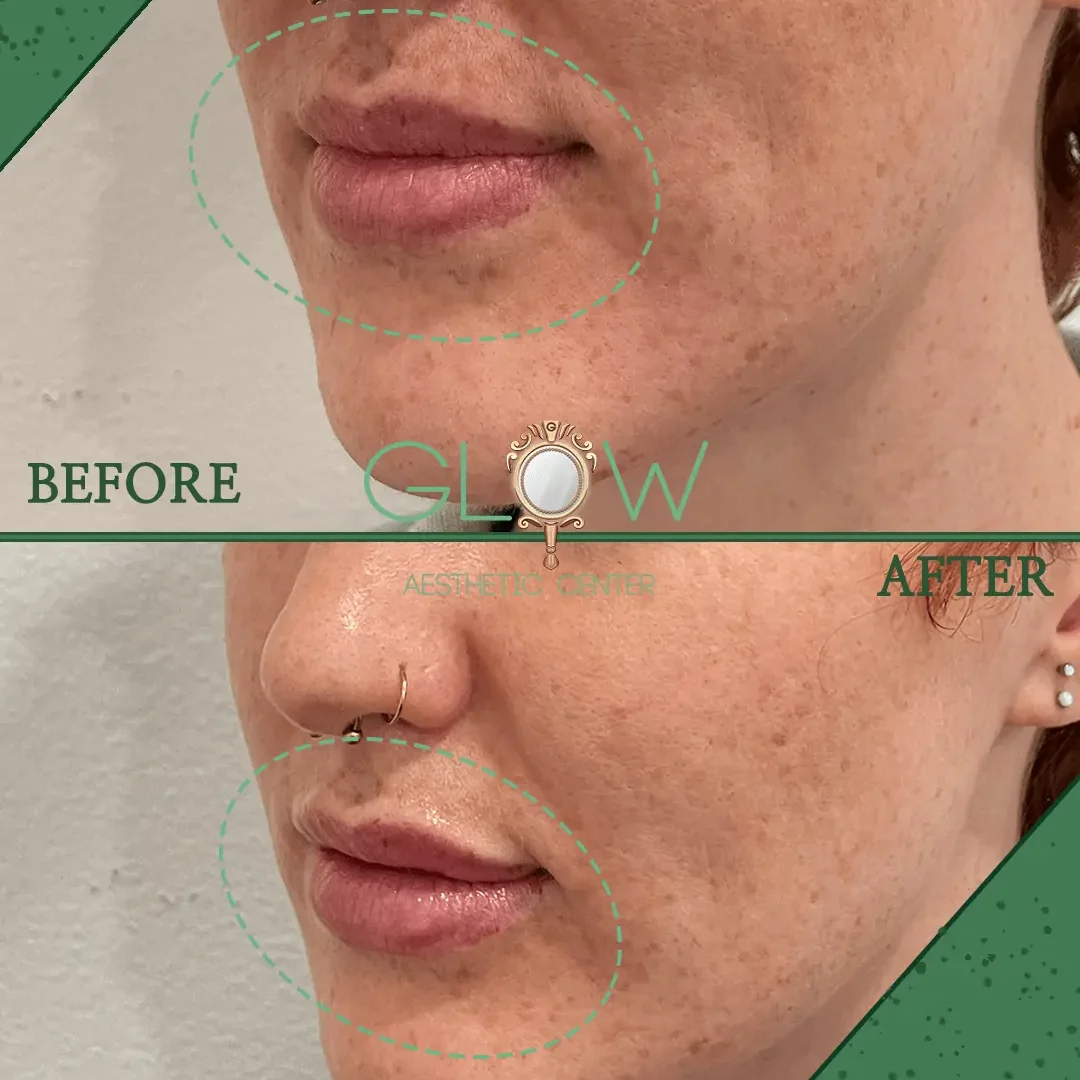 Lip-Filler-Before-and-After-Encino-CA-83