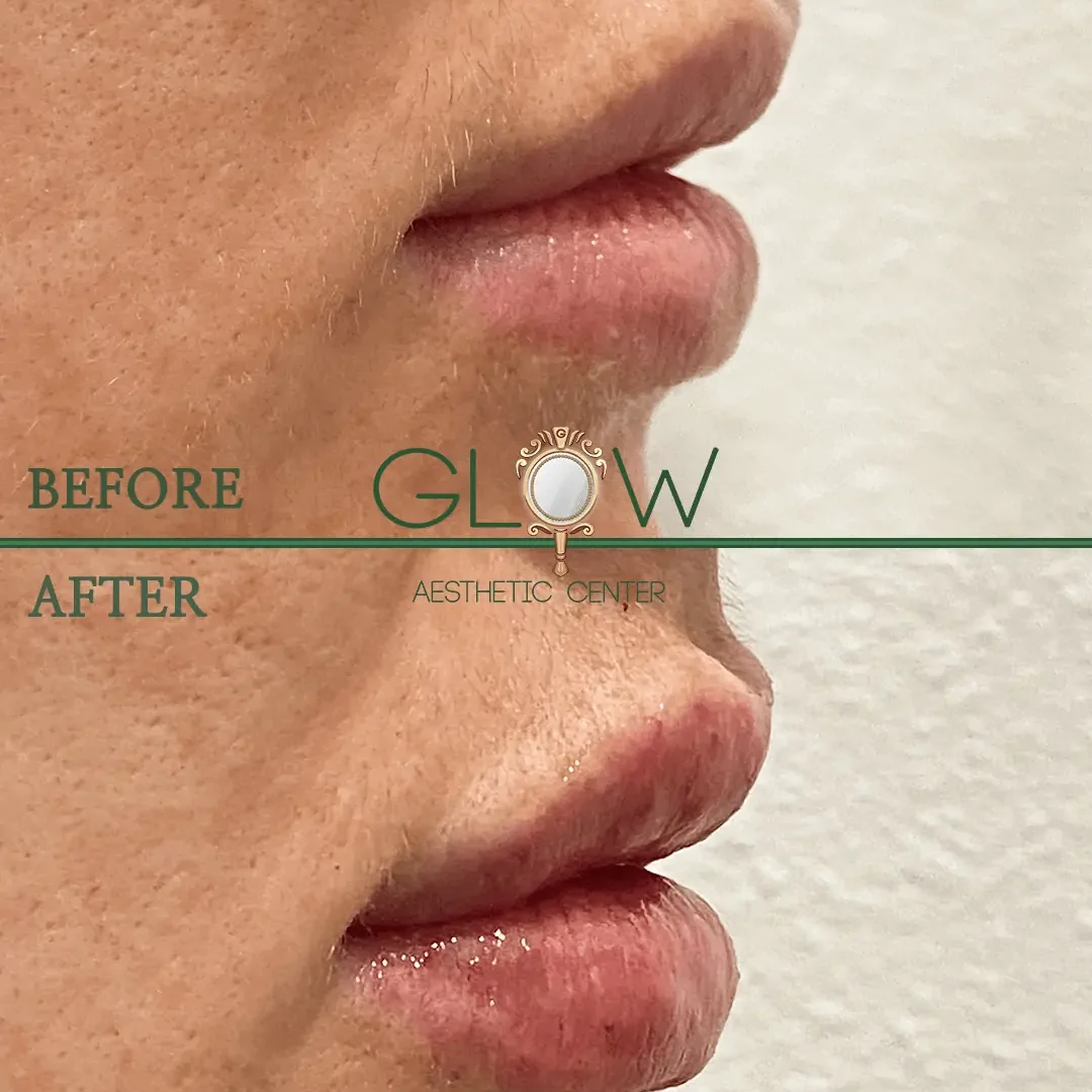 Lip-Filler-Before-and-After-Encino-CA-84
