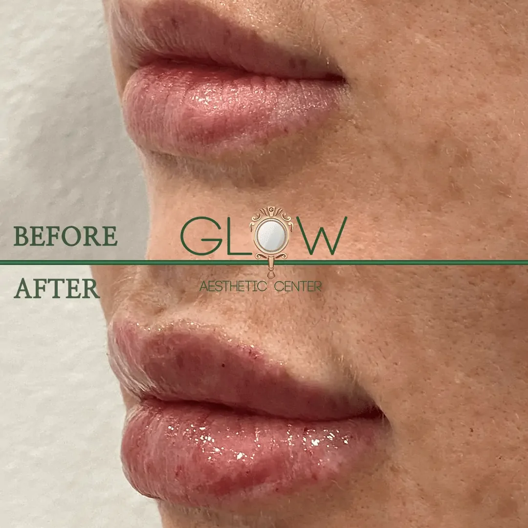 Lip-Filler-Before-and-After-Encino-CA-85