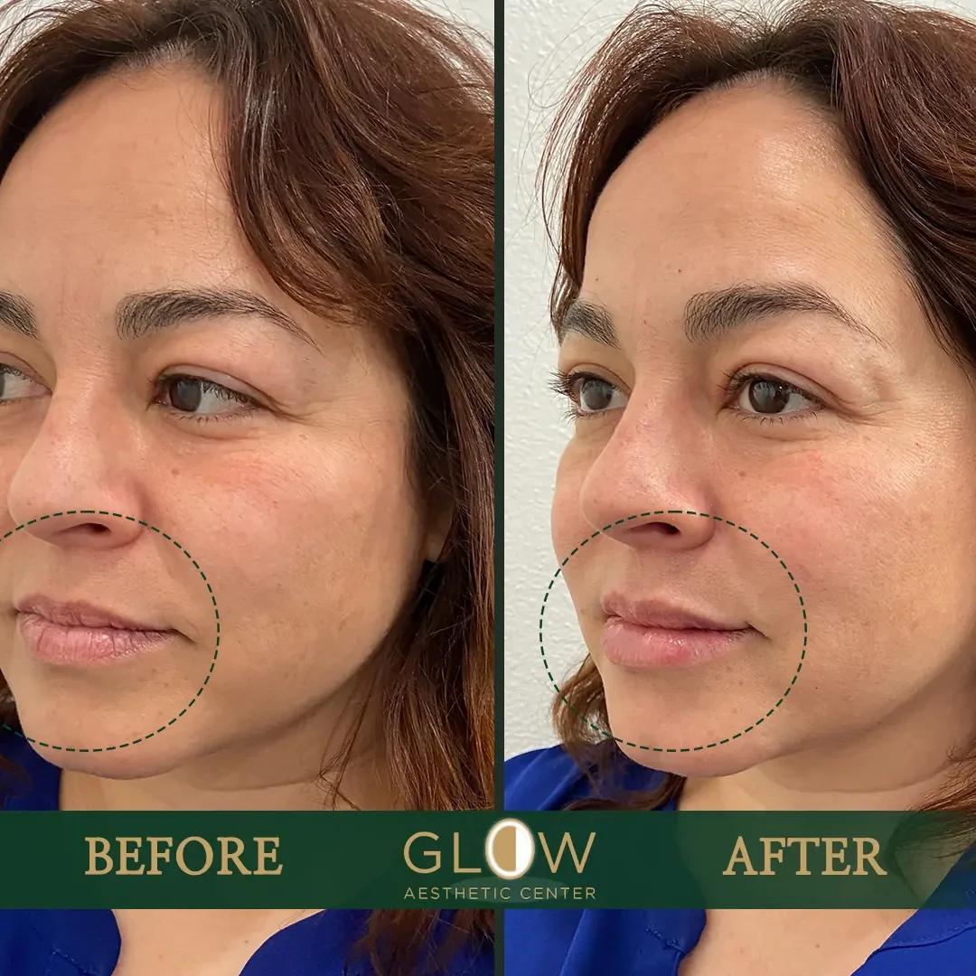 Lip-Filler-Before-and-After-Encino-CA-86