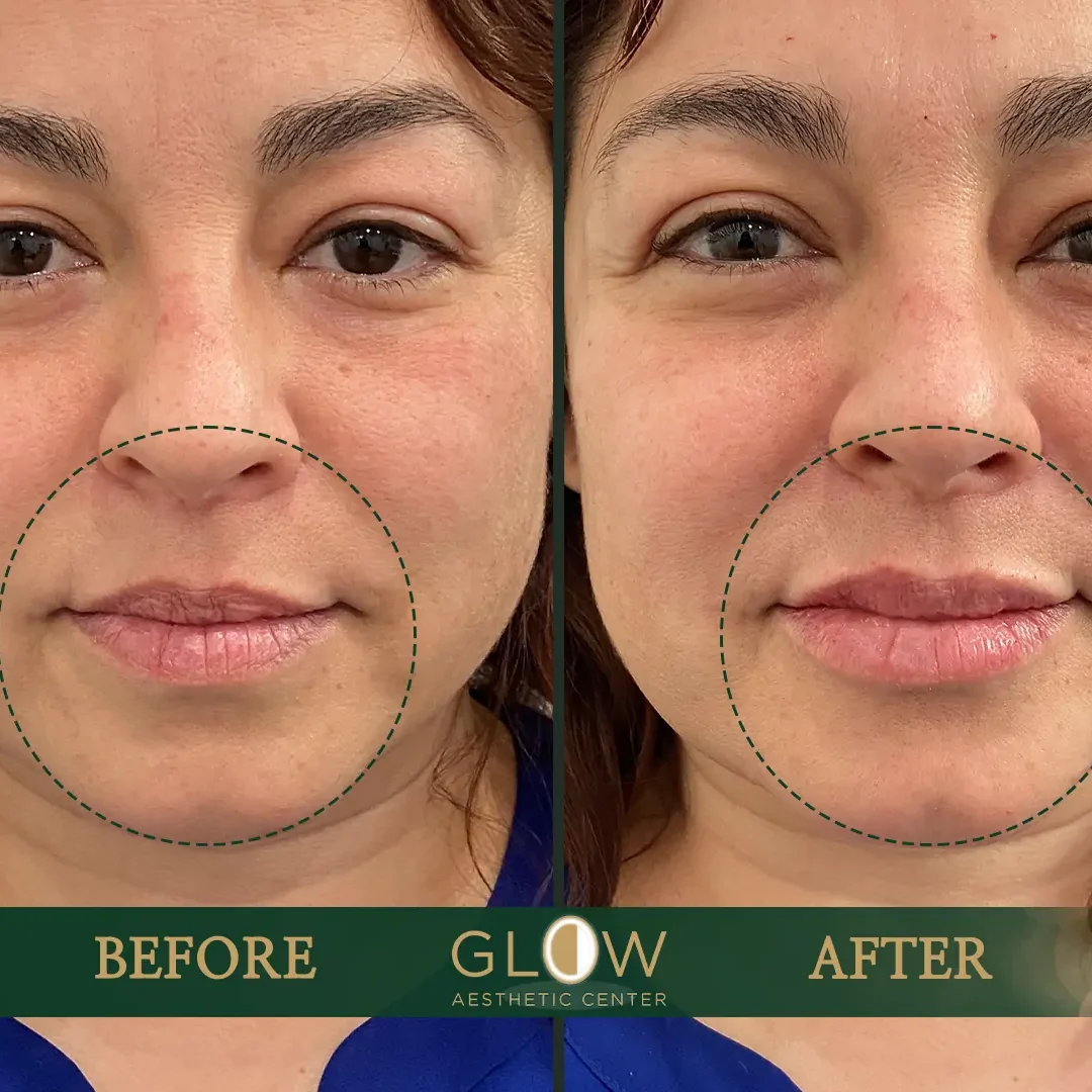 Lip-Filler-Before-and-After-Encino-CA-87