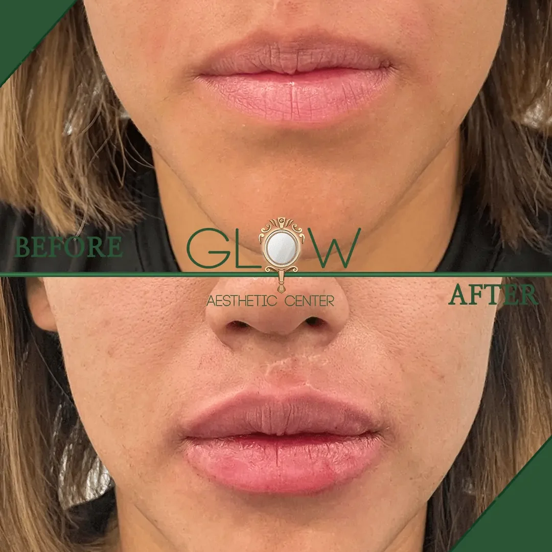 Lip-Filler-Before-and-After-Encino-CA-89