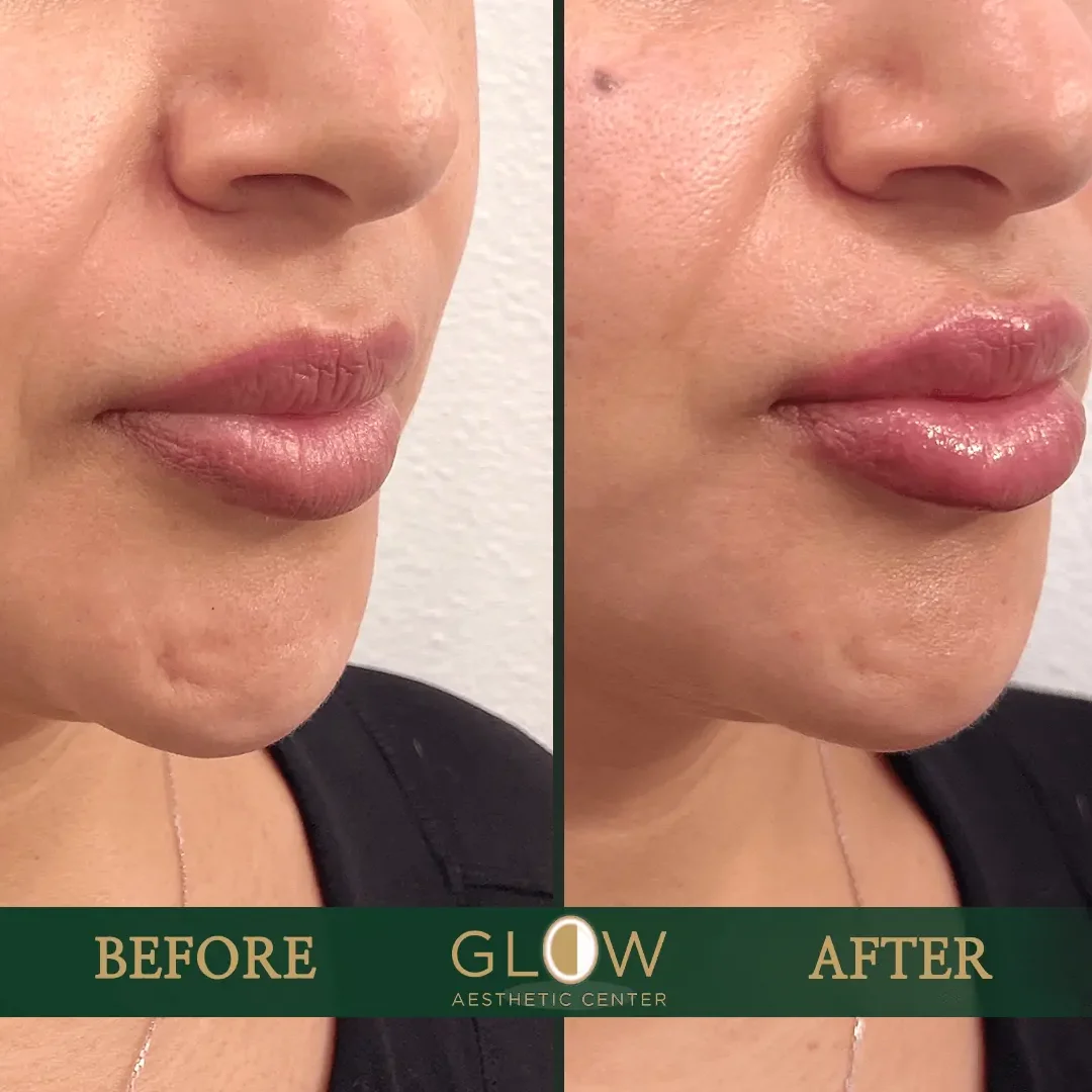 Lip-Filler-Before-and-After-Encino-CA-90