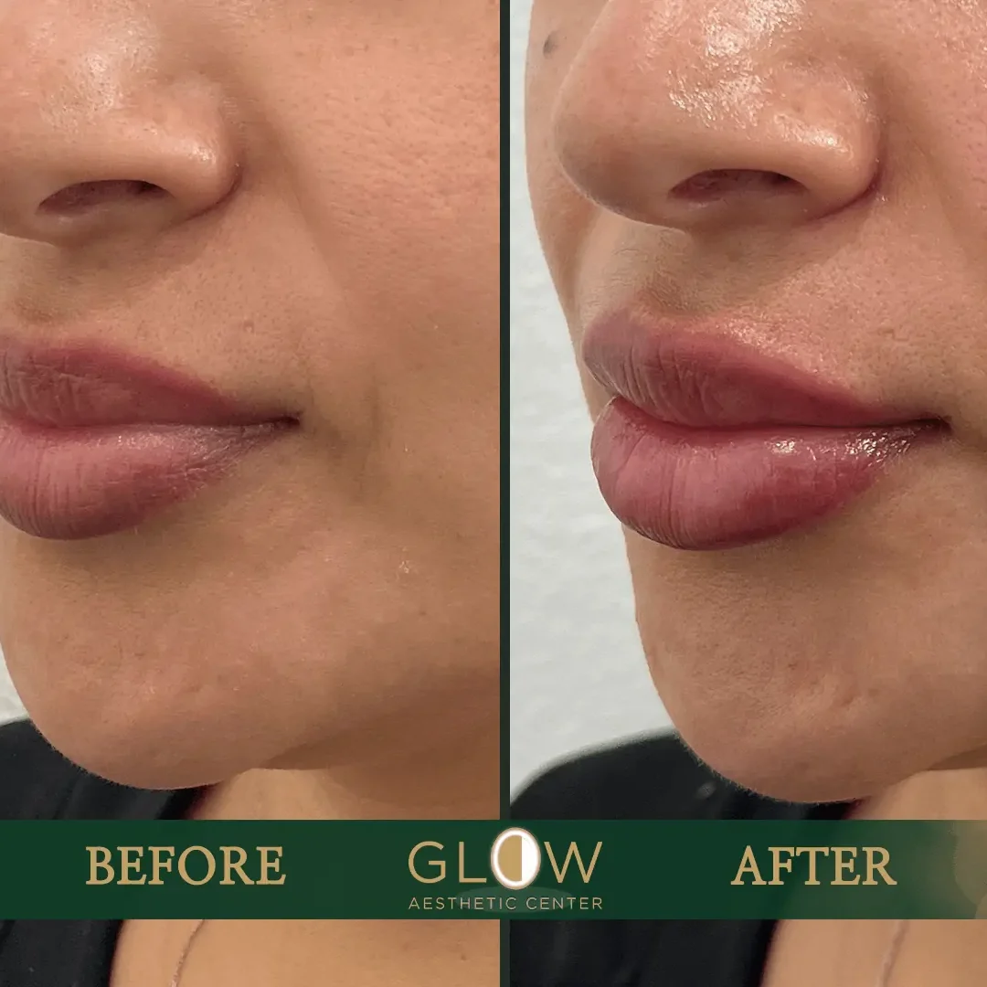 Lip-Filler-Before-and-After-Encino-CA-91