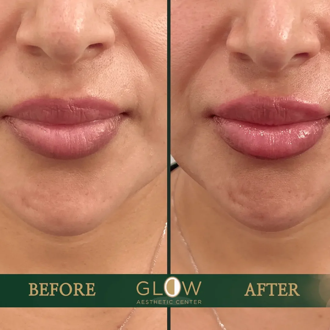 Lip-Filler-Before-and-After-Encino-CA-92
