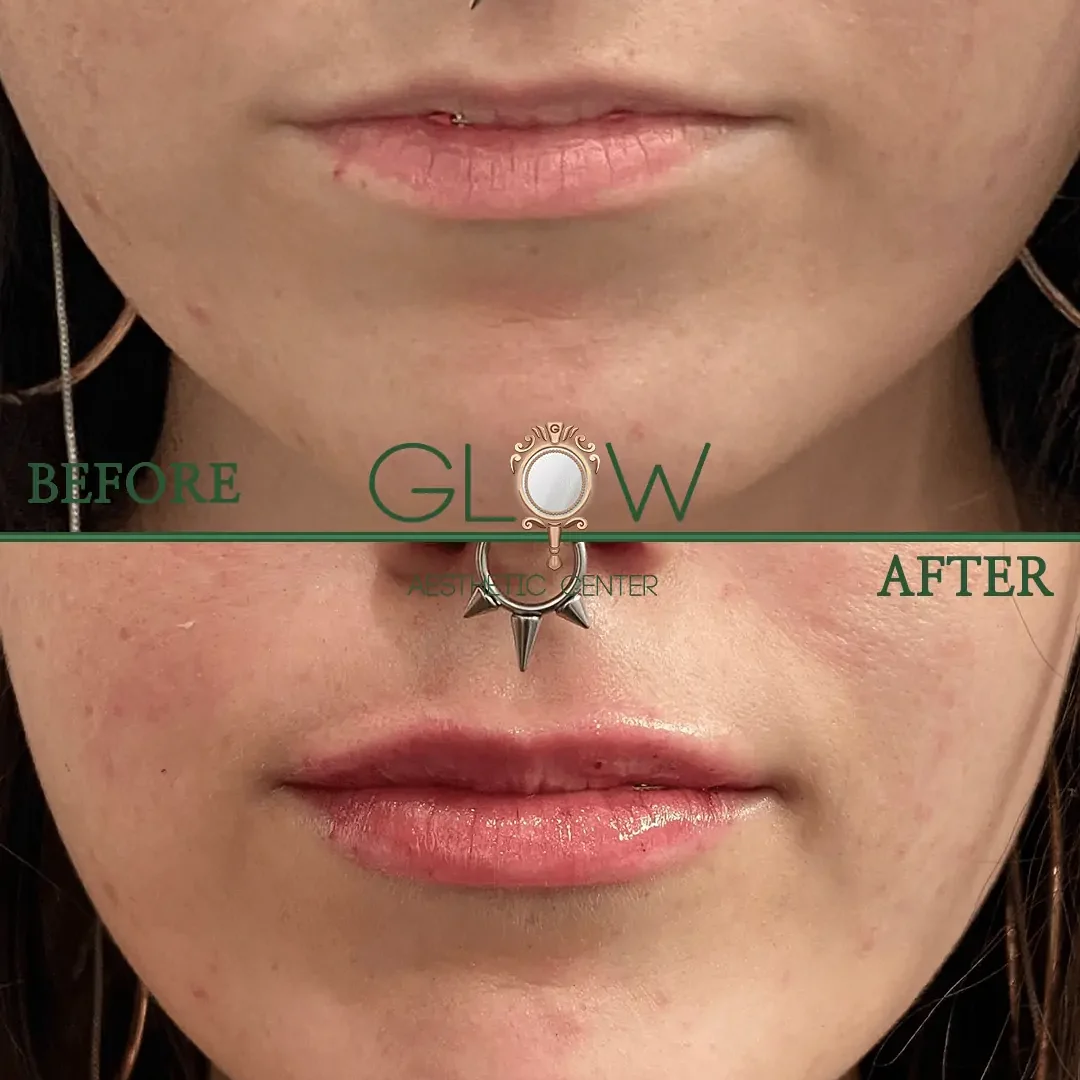 Lip-Filler-Before-and-After-Encino-CA-95