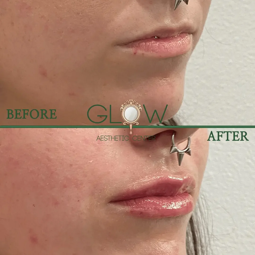 Lip-Filler-Before-and-After-Encino-CA-96