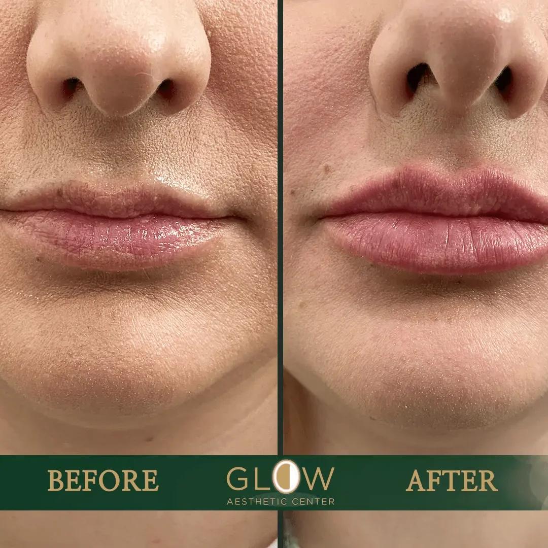Lip-Filler-Before-and-After-Encino-CA-97