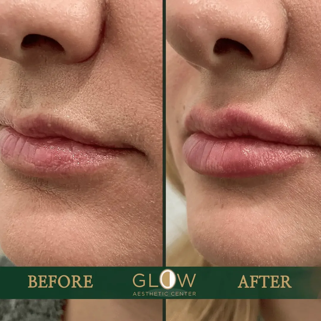 Lip-Filler-Before-and-After-Encino-CA-98