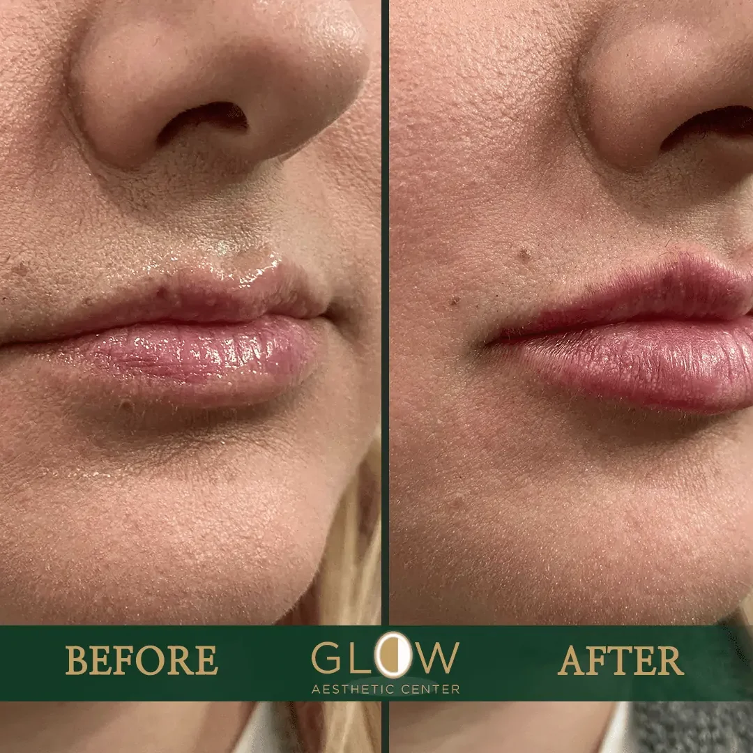 Lip-Filler-Before-and-After-Encino-CA-99